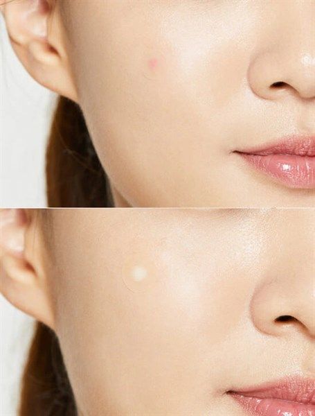 MIẾNG DÁN TRỊ MỤN COSRX CLEAR FIT MASTER PATCH 18 MIẾNG