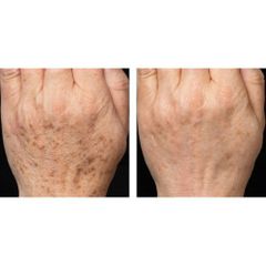 Kem Kpem trị đồi mồi, thâm nám, tàn nhang của Nga