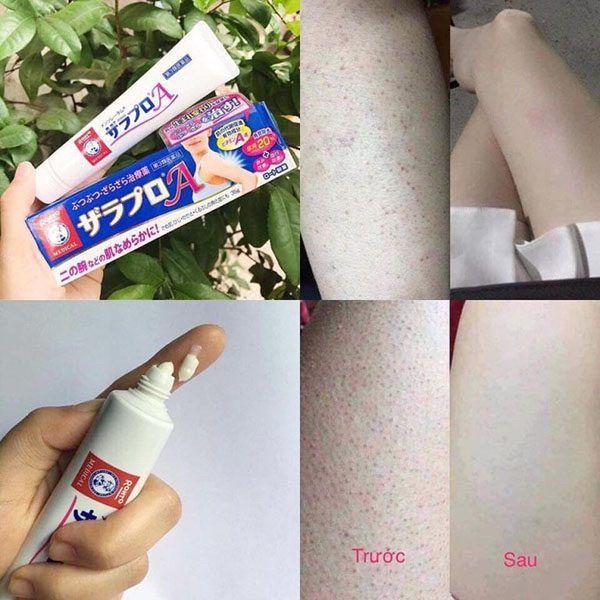 Kem trị viêm nang lông Rohto 35g