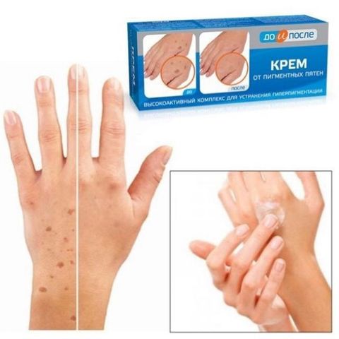 Kem Kpem trị đồi mồi, thâm nám, tàn nhang của Nga
