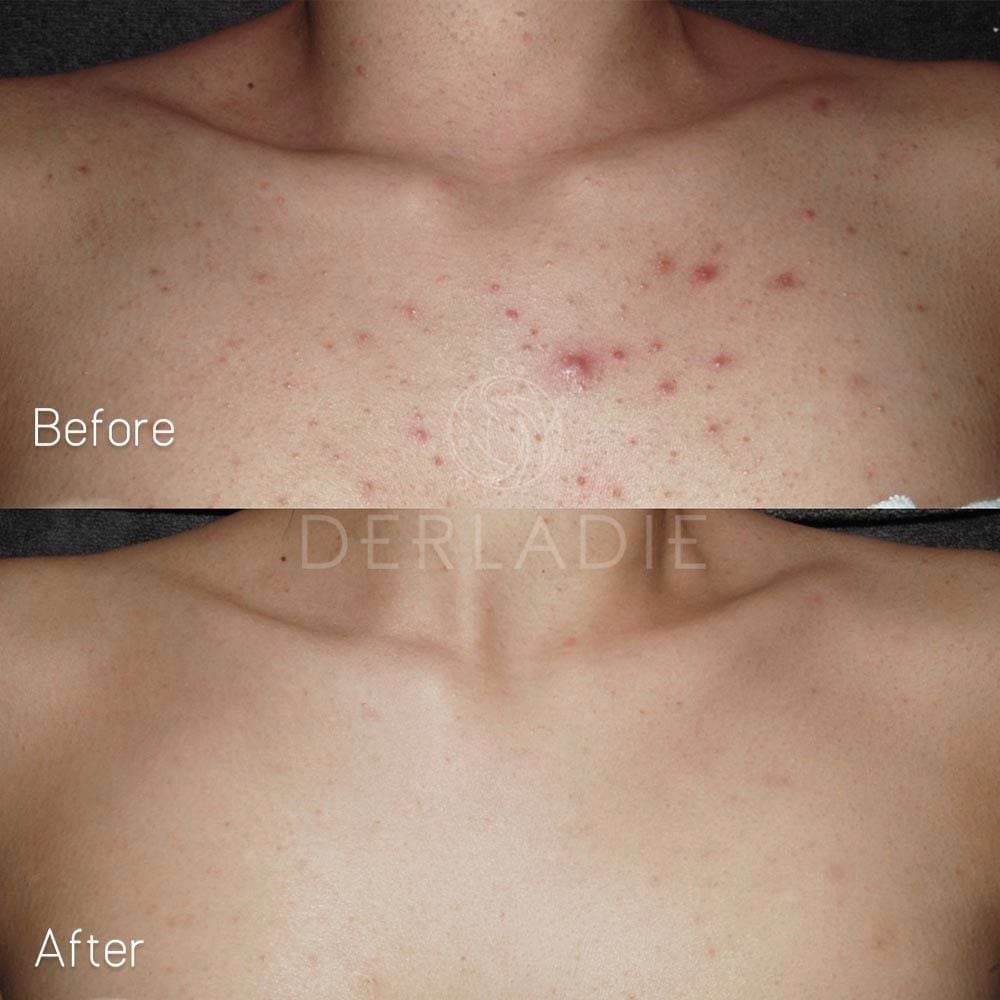 Xà Phòng Giảm Mụn Cơ Thể Derladie Body Cleansing Bar For Blemish Skin 50g