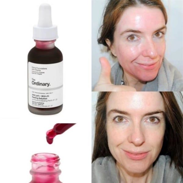 serum tẩy da chết The Ordinary AHA30% +BHA 2% PEELING 30ML CANADA 30ml