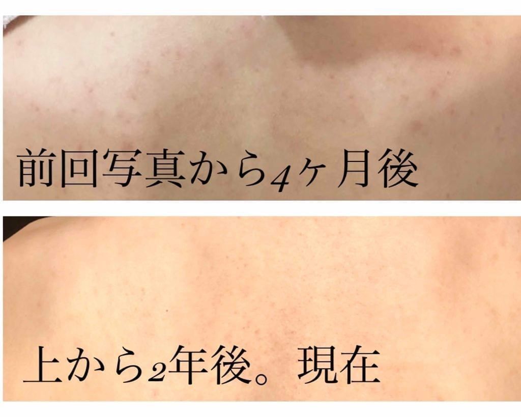 Xà Phòng Trị Mụn Lưng Pelican For Back Medicated Soap 135g