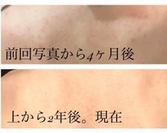 Xà Phòng Trị Mụn Lưng Pelican For Back Medicated Soap 135g