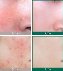 Nước Hoa Hồng Hỗ Trợ Giảm Mụn, Tẩy Tế Bào Chết Hóa Học Cosrx AHA/BHA Clarifying Treatment Toner