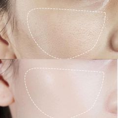 Serum Bor-tox MEDIPEEL