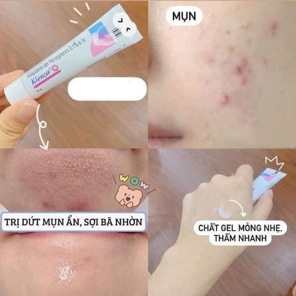 Trị mụn Klenzit MS