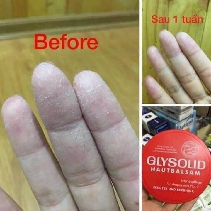 DƯỠNG DA TOÀN THÂN, TRỊ NỨT GÓT CHÂN   GLYSOLID  ĐỨC