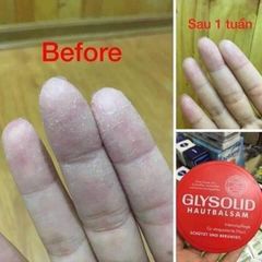 DƯỠNG DA TOÀN THÂN, TRỊ NỨT GÓT CHÂN   GLYSOLID  ĐỨC