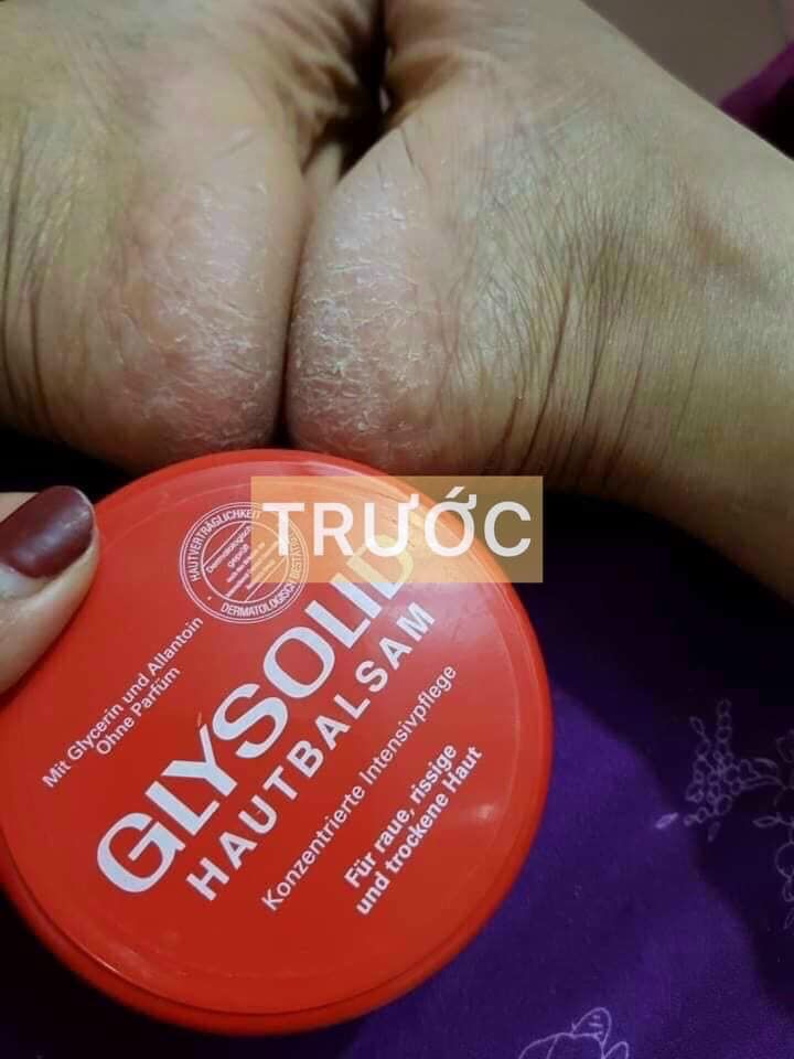 DƯỠNG DA TOÀN THÂN, TRỊ NỨT GÓT CHÂN   GLYSOLID  ĐỨC
