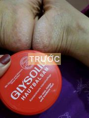 DƯỠNG DA TOÀN THÂN, TRỊ NỨT GÓT CHÂN   GLYSOLID  ĐỨC