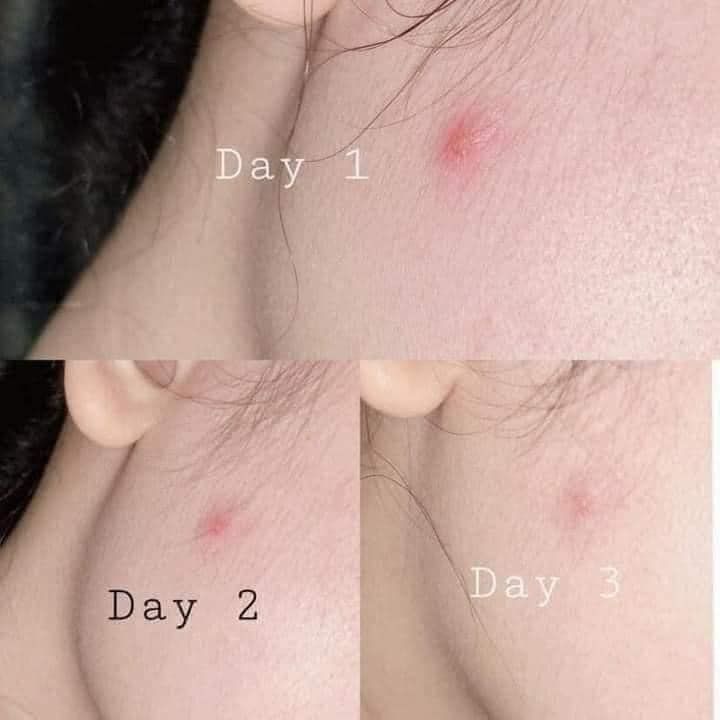 Trị mụn LUMOS