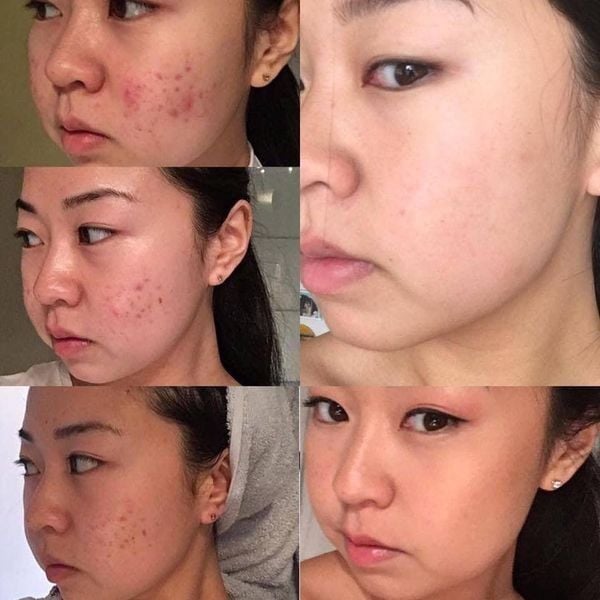 TRETINOIN 0.1% ( Ấn độ )