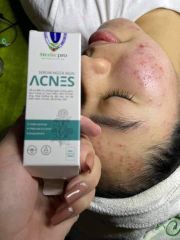Serum ngừa mụn ACNES CGF