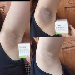 Trị thâm vùng nách OI Cell