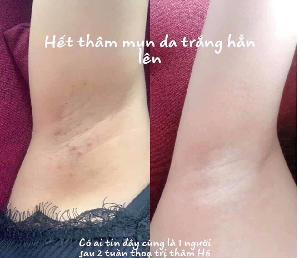 Kem trị thâm hồng nhũ hoa Nuwhite V1