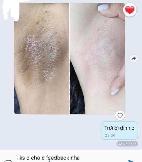 Kem trị thâm hồng nhũ hoa Nuwhite V1