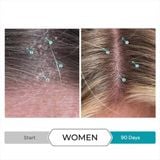  Dầu gội trị gầu, vảy nến, tẩy tế bào chết, nuôi dưỡng da Dandrene Anti - Dandruff shampoo 205ml 