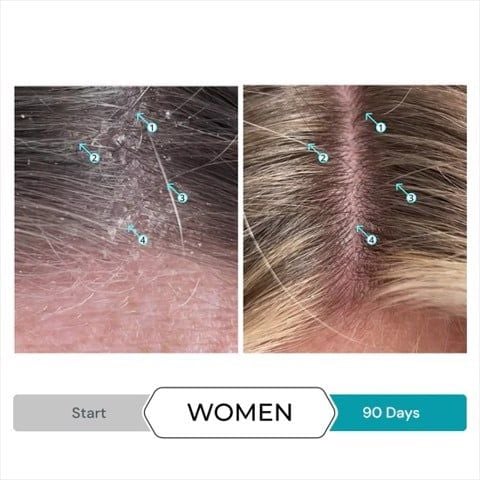  Dầu gội trị gầu, vảy nến, tẩy tế bào chết, nuôi dưỡng da Dandrene Anti - Dandruff shampoo 205ml 