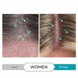  Dầu xả nuôi dưỡng, trị gầu, vảy nến Dandrene Anti - Dandruff conditioner 205ml 