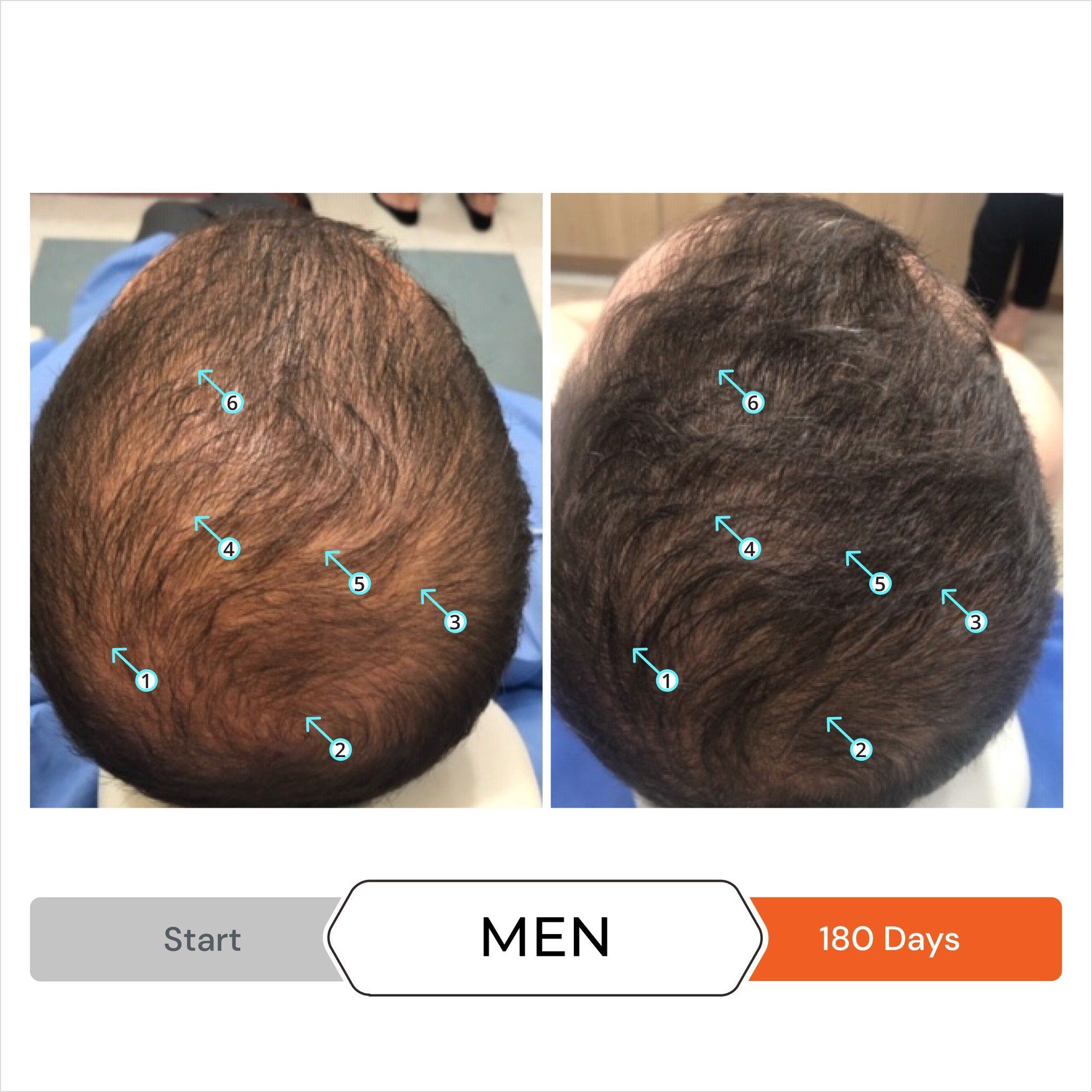  Viên hỗ trợ mọc tóc, kiểm soát rụng tóc REVITA 30 TABLETS 