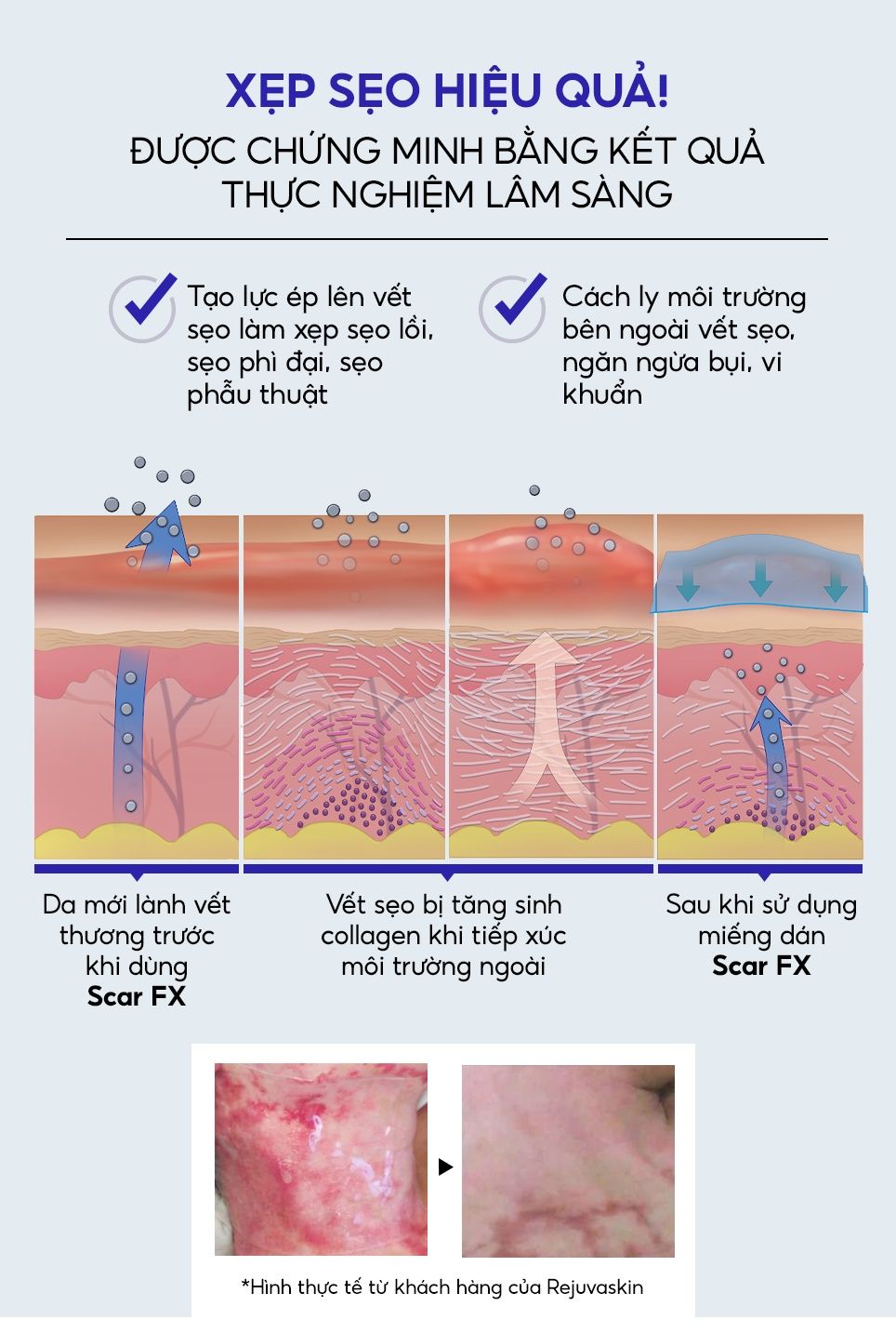  Miếng Dán Sẹo Lồi / Phì Đại REJUVASKIN Scar FX 5cm X 10cm 