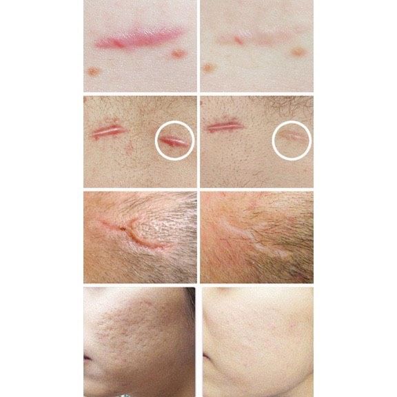  Gel xoá mờ sẹo thâm, rỗ, lõm Strataderm 10g Thuỵ Sĩ 