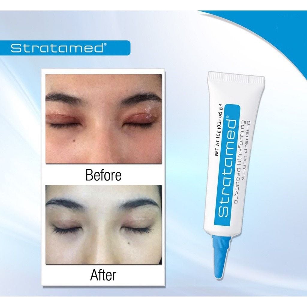  Gel liền vết thương hở sau phẫu thuật, ngăn ngừa sẹo Stratamed Thuỵ Sĩ 