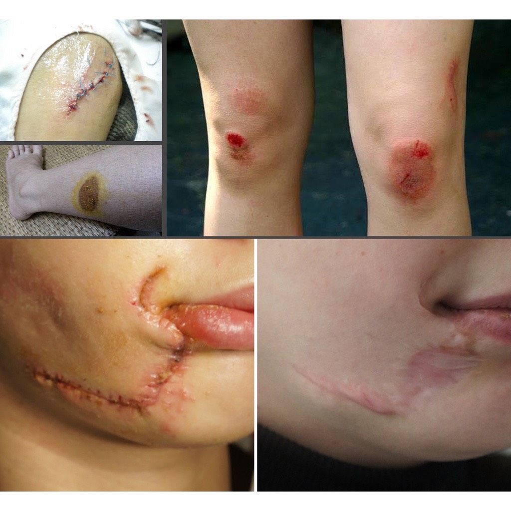  Gel phục hồi vết thương hở sau phẫu thuật, ngăn ngừa sẹo thâm, sẹo rỗ, sẹo lõm, sẹo phì đại Stratamed 10G Thuỵ Sĩ 