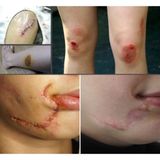  Gel Silicon bảo vệ và làm lành vết thương hở Stratamed 5G Stratpharma 