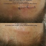  Gel phục hồi vết thương hở sau phẫu thuật, ngăn ngừa sẹo thâm, sẹo rỗ, sẹo lõm, sẹo phì đại Stratamed 10G Thuỵ Sĩ 