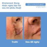  Gel liền vết thương hở sau phẫu thuật, ngăn ngừa sẹo Stratamed Thuỵ Sĩ 