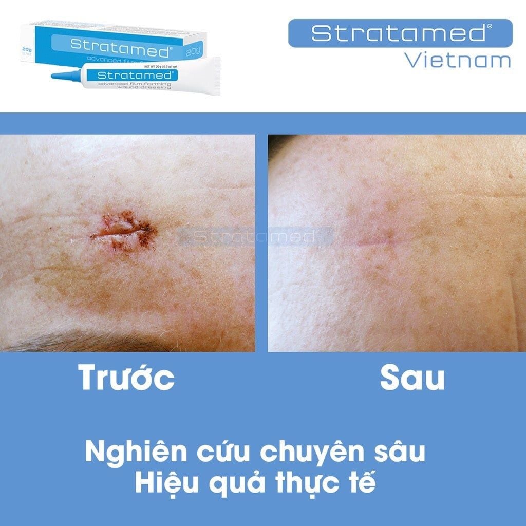  Gel liền vết thương hở sau phẫu thuật, ngăn ngừa sẹo Stratamed Thuỵ Sĩ 