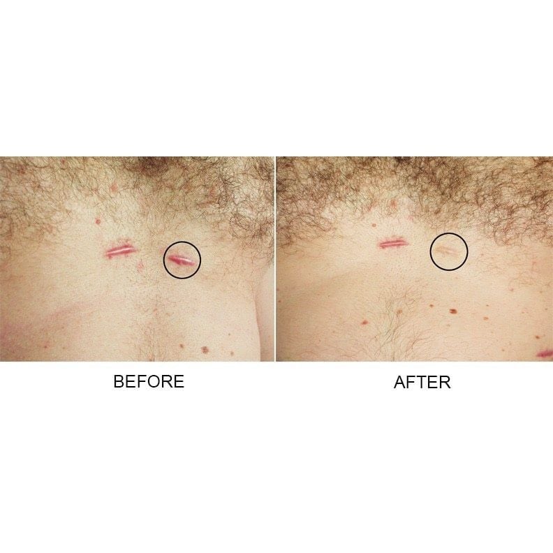  Gel xoá mờ sẹo thâm, rỗ, lõm Strataderm 20g Thuỵ Sĩ 