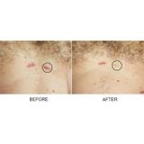  Gel xoá mờ sẹo thâm, rỗ, lõm Strataderm 10g Thuỵ Sĩ 