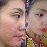  Gel xoá mờ sẹo thâm, rỗ, lõm Strataderm 20g Thuỵ Sĩ 