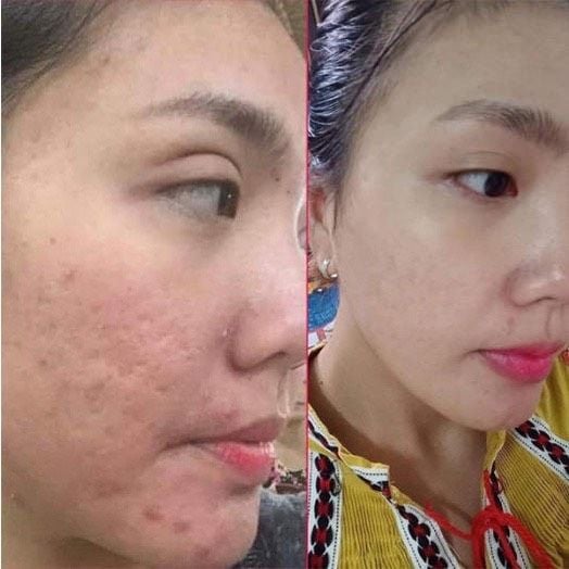  Gel xoá mờ sẹo thâm, rỗ, lõm Strataderm 20g Thuỵ Sĩ 