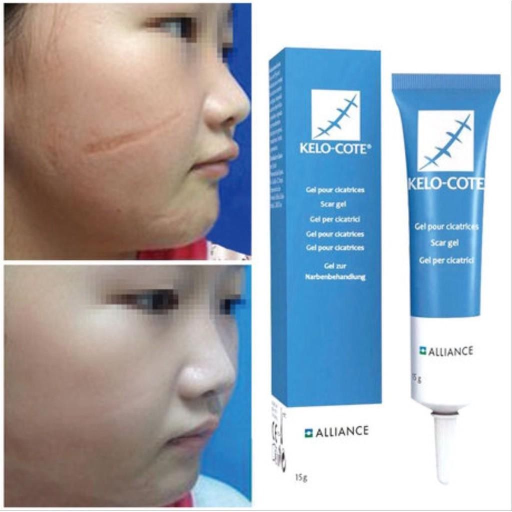  Kem Ngừa Sẹo Lồi, Sẹo Lõm, Sẹo Phẫu Thuật, Sẹo Lâu Năm Kelo-Cote 