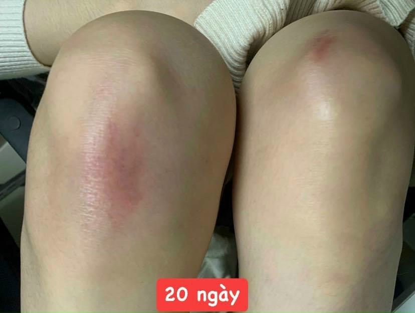  Kem Ngừa Sẹo Lồi, Sẹo Lõm, Sẹo Phẫu Thuật, Sẹo Lâu Năm Kelo-Cote 