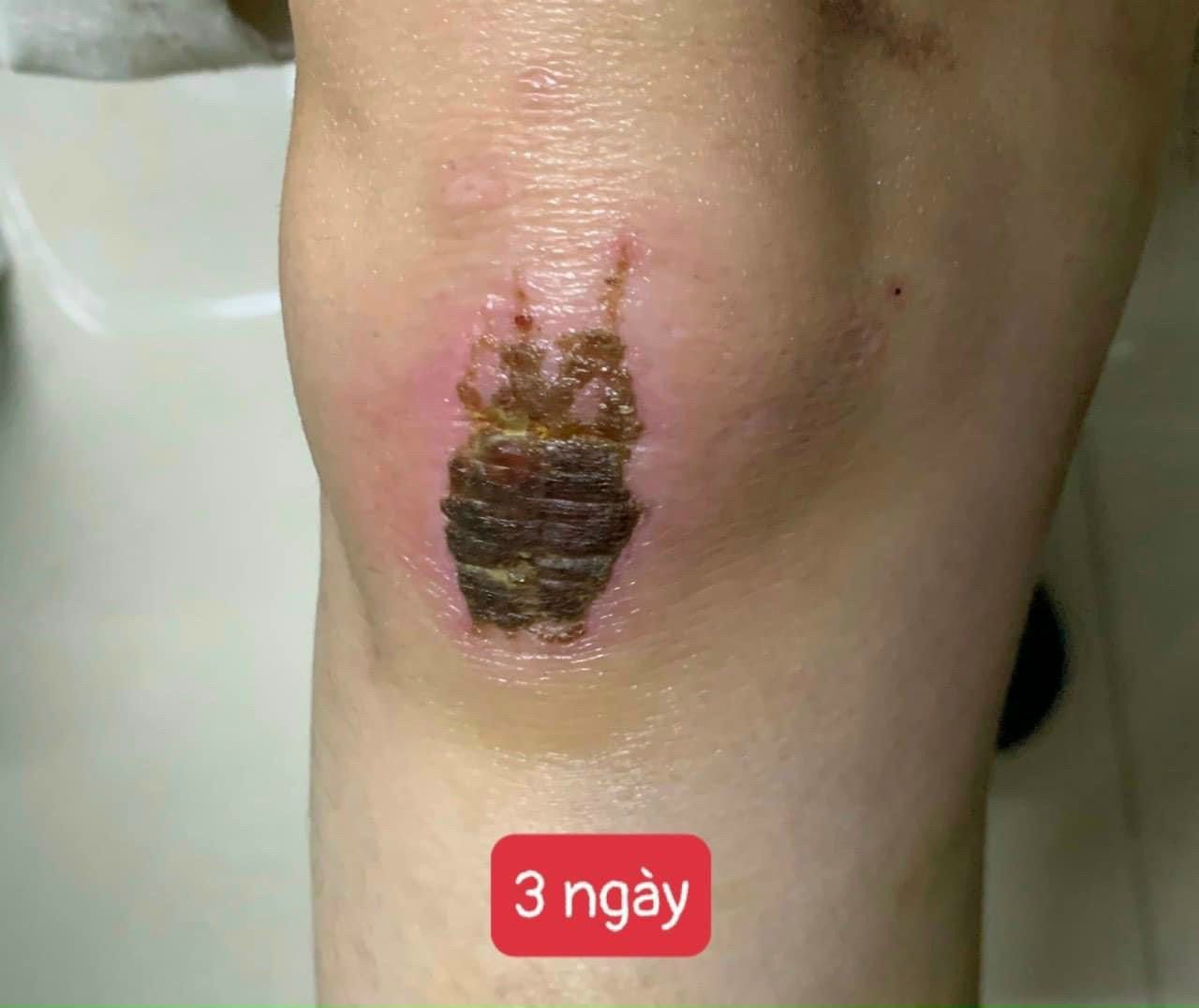  Kem Ngừa Sẹo Lồi, Sẹo Lõm, Sẹo Phẫu Thuật, Sẹo Lâu Năm Kelo-Cote 