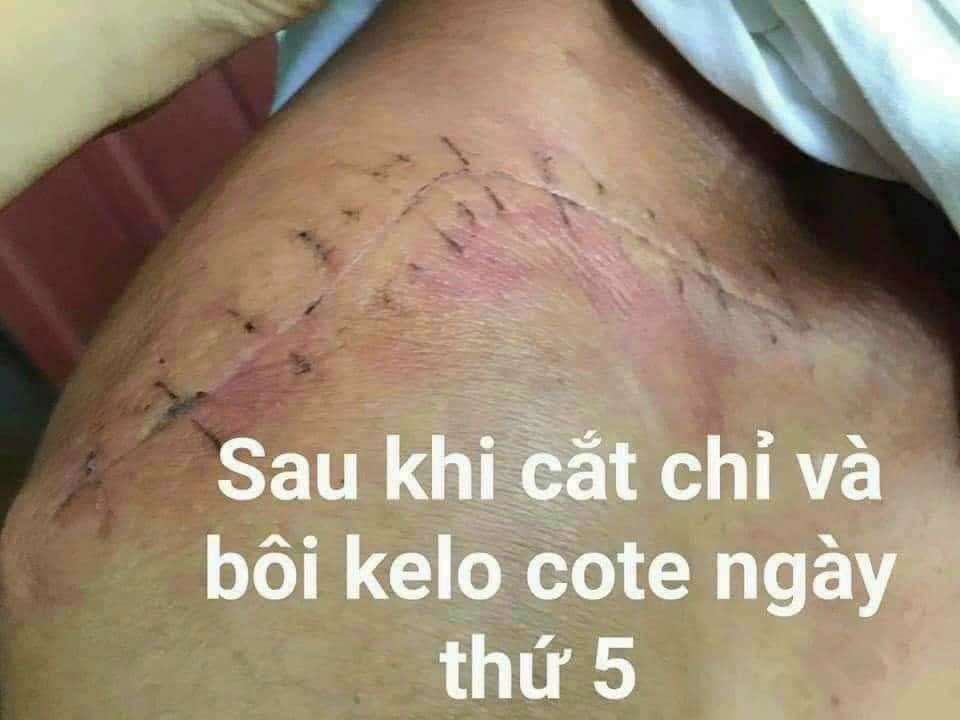  Kem Ngừa Sẹo Lồi, Sẹo Lõm, Sẹo Phẫu Thuật, Sẹo Lâu Năm Kelo-Cote 