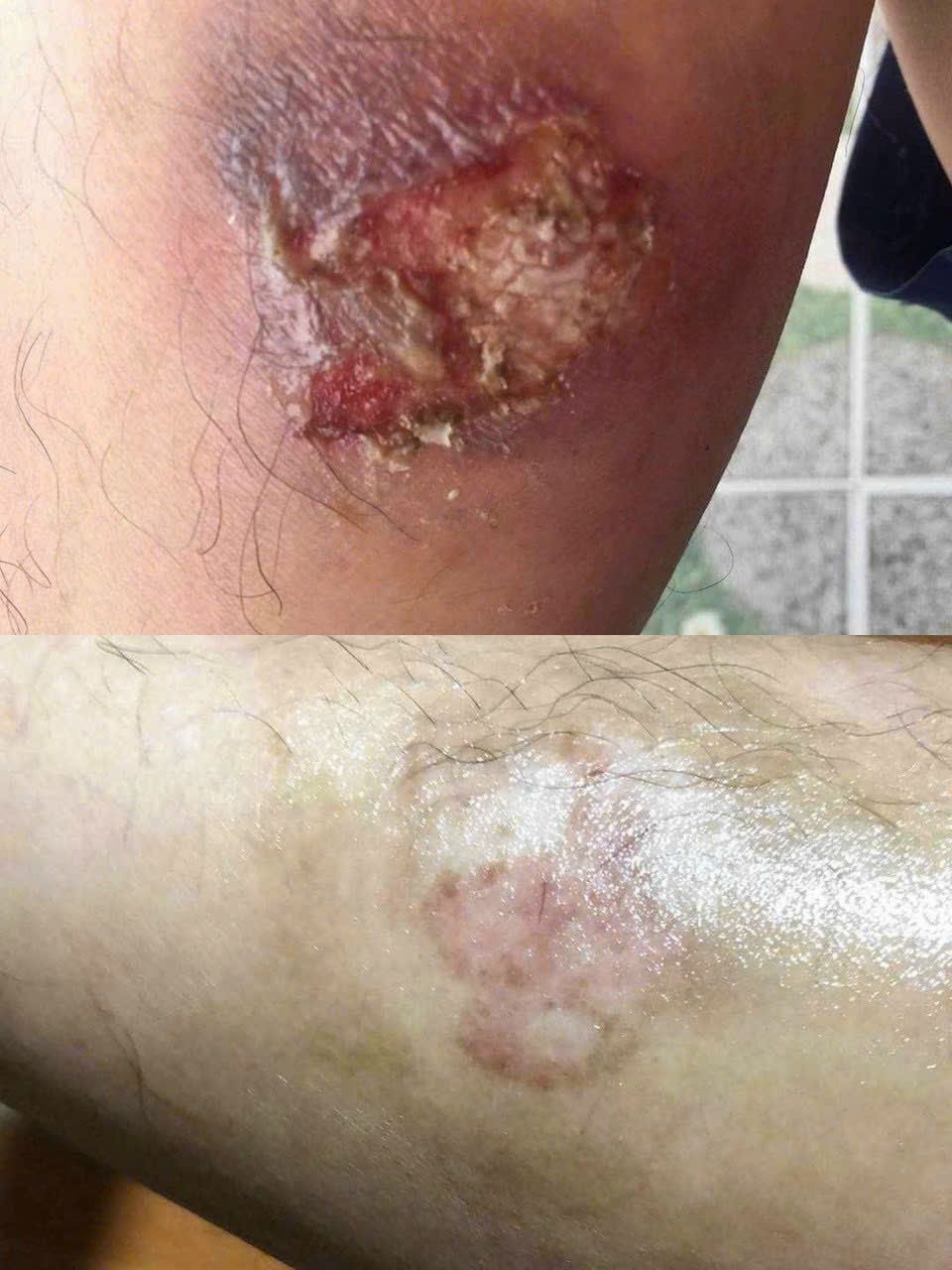  Kem Ngừa Sẹo Lồi, Sẹo Lõm, Sẹo Phẫu Thuật, Sẹo Lâu Năm Kelo-Cote 