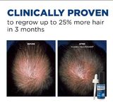  Gel Mọc Tóc Nam Giới Men's Rogaine Extra Strength 