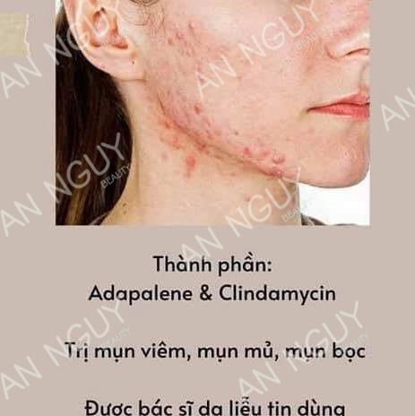 Gel Trị Mụn Glenmark Klenzit-C Gel Dành Cho Da Bị Mụn Trứng Cá, Mụn Viêm Đỏ 15gr