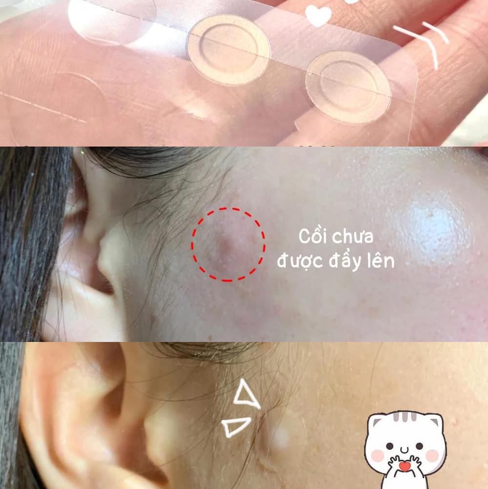 Miếng Dán Mụn Some By Mi Spot Patch 18 Miếng