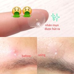 Miếng Dán Mụn Some By Mi Spot Patch 18 Miếng