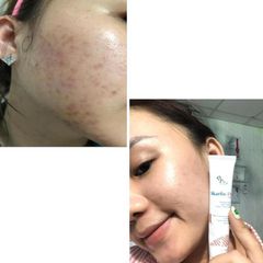 Kem Dưỡng Fixderma Skarfix-TX Cream Giảm Thâm Sạm 15gr