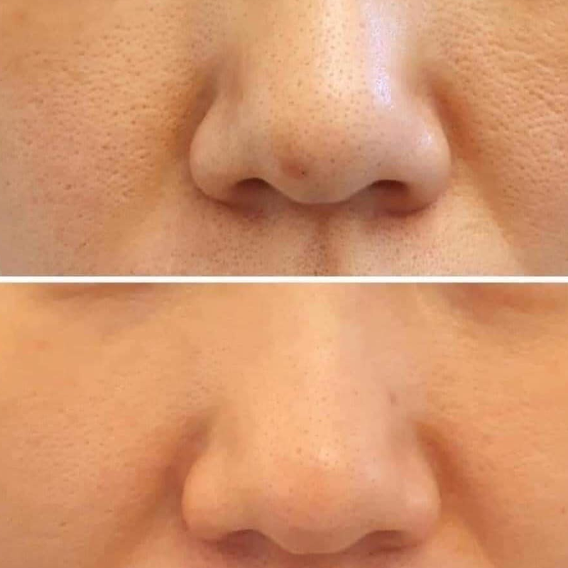 Tinh Chất Derma Factory Niacinamide 20% Serum Kiểm Soát Nhờn Se Khít Lỗ Chân Lông 30ml