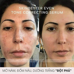 Tinh Chất Làm Giảm Nám, Sáng Da SkinBetter Science Even Tone Correcting Serum 50ml