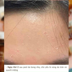 Tinh Chất Thay Da Sinh Học NeoStrata Prosystem Retinol Peel (Ống 1.5ml)